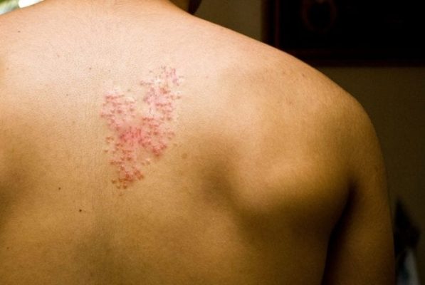 man with shingles at the back | how long does shingles last
